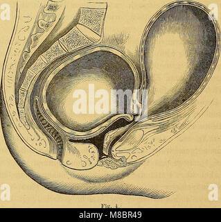 Diagnostizieren, Pathologie und Therapie der Frauen-Krankheiten (1869) (14778308712) Stockfoto