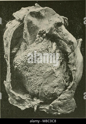 Erkrankungen der Brust und der Prinzipien der physischen Diagnose (1920) (14593533658) Stockfoto