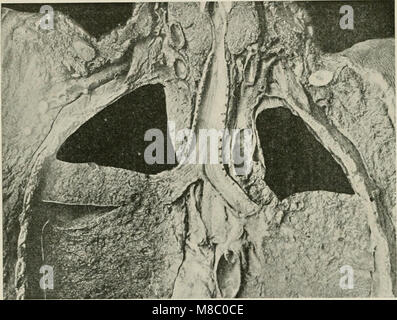 Erkrankungen der Brust und der Prinzipien der physischen Diagnose (1920) (14756803746) Stockfoto