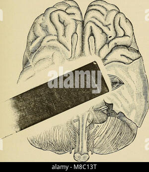 Erkrankungen des Nervensystems - für den Arzt für Allgemeinmedizin und Student (1913) (14579682729) Stockfoto