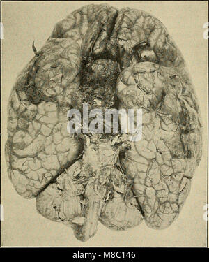 Erkrankungen des Nervensystems - für den Arzt für Allgemeinmedizin und Student (1913) (14766300405) Stockfoto