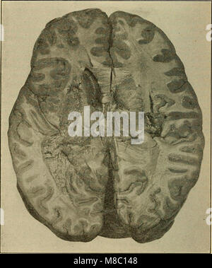 Erkrankungen des Nervensystems - für den Arzt für Allgemeinmedizin und Student (1913) (14786162483) Stockfoto