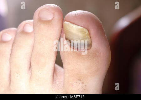 Schließen Sie herauf Bild der rechten Fuß Toe Nagel Pilz Infektion leiden auf weißem Hintergrund. Stockfoto