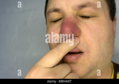 Pickel Auf Der Nase Schmerzt Und Juckt Stockfotografie Alamy