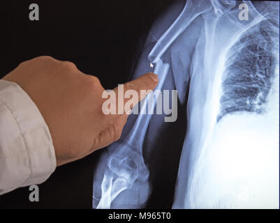 X-ray Image der gebrochenen Arm auf dem Monitor des PC. Der Doktor zeigt mit dem Finger auf einen gebrochenen Arm. Stockfoto