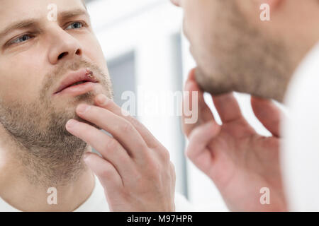 Junge Menschen leiden unter schmerzhaften Herpes auf den Mund Stockfoto