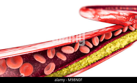 Die Bildung von Cholesterin, Fett, Arterie, Vene, Herz. Einengung der Vene für fat Bildung Stockfoto