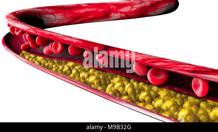 Die Bildung von Cholesterin, Fett, Arterie, Vene, Herz. Einengung der Vene für fat Bildung Stockfoto