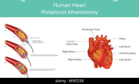 Atherectomy ist ein Verfahren, das durchgeführt wird, um atherosklerotischen Plaque aus erkrankten Arterien zu entfernen. Arteriosklerotische Plaques sind entweder lokalisiert. Stock Vektor