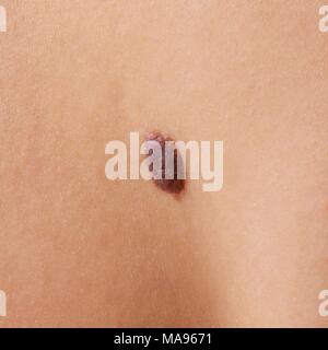 Auf der Haut Mole, aus der Nähe. Stockfoto