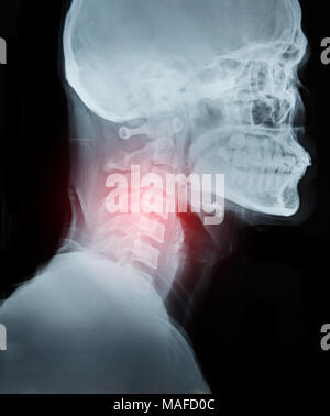 X-ray Image Film detail von Hals- und Red Zone Schmerz. Stockfoto