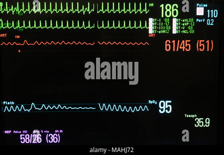 Monitor supraventrikuläre Tachykardie in Grün, arterieller Blutdruck in Rot, in blau Pulsoxymetrie, nichtinvasive Blutdruckmessung in Lavendel Stockfoto