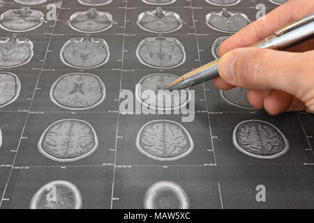 Arzt hand mit einem Stift bei einem MRT-Scan zeigt (transversale Ansicht) des menschlichen Gehirns Stockfoto