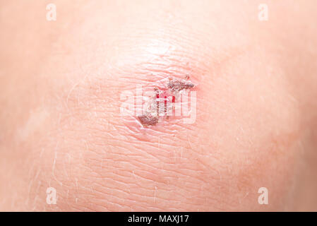 Verletzungen auf der Haut Stockfoto