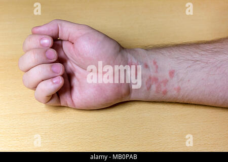 Nahaufnahme von roten entzündeten Krankheit Flecken auf den Händen eines Mannes. Stockfoto