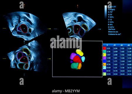 Buntes Bild der modernen Ultraschall-Monitor. Ultraschallgerät. High-Tech-Medizin und Gesundheit-Ausrüstung. Ultraschall-Bildgebung oder sonogra Stockfoto