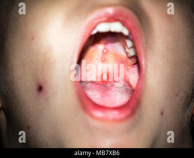 Nahaufnahme von Varicella-zoster Virus oder Windpocken bubble Hautausschlag und Noppen innen des Kindes Mund am weichen Gaumen. Dermatologie Begriff. Stockfoto