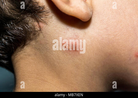 Nahaufnahme von Varicella-zoster Virus oder Windpocken bubble Hautausschlag im Gesicht und Hals des Kindes. Dermatologie Begriff. Stockfoto