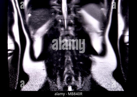 Fahrt durch die menschlichen Bauch und Brust durch 18 MRT-Schnitte (koronale Ansicht). Bild 15/18 Stockfoto