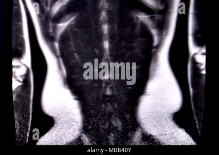 Fahrt durch die menschlichen Bauch und Brust durch 18 MRT-Schnitte (koronale Ansicht). Bild 17/18 Stockfoto