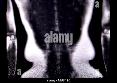 Fahrt durch die menschlichen Bauch und Brust durch 18 MRT-Schnitte (koronale Ansicht). Bild 18/18 Stockfoto