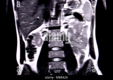 Fahrt durch die menschlichen Bauch und Brust durch 18 MRT-Schnitte (koronale Ansicht). Bild 7/18 Stockfoto