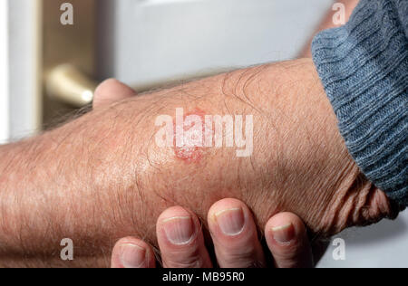 Ekzem auf dem Arm eines Mannes, in der Nähe Stockfoto