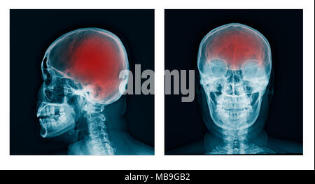 Schädel x-ray AP/Seitenansicht Stockfoto