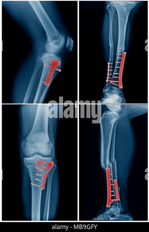 Sammlung von Bein mit post Betrieb interne Fixation Tibia und fibular Knochen Stockfoto