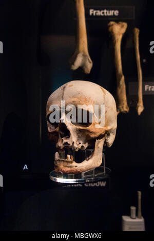 Menschliche Schädel aus Wrack der Mary Rose; Kriegsschiff der englischen Tudor navy von König Henry VIII. Die Mary Rose Museum, Historic Dockyard, Portsmouth. Großbritannien Stockfoto