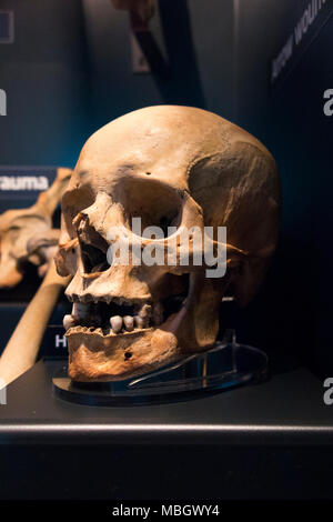 Menschliche Schädel aus Wrack der Mary Rose; Kriegsschiff der englischen Tudor navy von König Henry VIII. Die Mary Rose Museum, Historic Dockyard, Portsmouth. Großbritannien Stockfoto