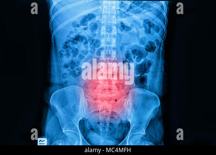 Röntgenaufnahme der Wirbelsäule und des Beckens von einem menschlichen Körper Teil zeigen Lendenwirbelsäulenspondylose Stockfoto