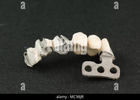 Beschädigte zahnmedizinische cermet Brücke Prothese auf eine lamellare Implantat Stockfoto