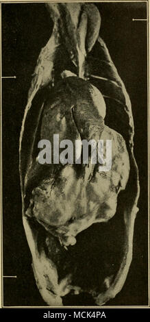 . Abb. 69. - Huhn tumor XVIII im Muskelmagen des ursprünglichen Geflügel. Drei Metastasen sind in der Skelettmuskulatur sichtbar und zwar im Nacken, der Andere in der Höhe der Brustwirbelsäule Wand über dem rechten Lappens der Leber und der Dritte auf die Innenfläche des Beckens. Alle sind durch Pfeile gekennzeichnet. (Nach Rous und Lauge). Stockfoto