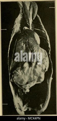 . Abb. 69. - Huhn tumor XVIII im Muskelmagen des ursprünglichen Geflügel. Drei Metastasen sind in der Skelettmuskulatur sichtbar und zwar im Nacken, der Andere in der Höhe der Brustwirbelsäule Wand über dem rechten Lappens der Leber und der Dritte auf die Innenfläche des Beckens. Alle sind durch Pfeile gekennzeichnet. (Nach Rous und Lange.) Stockfoto