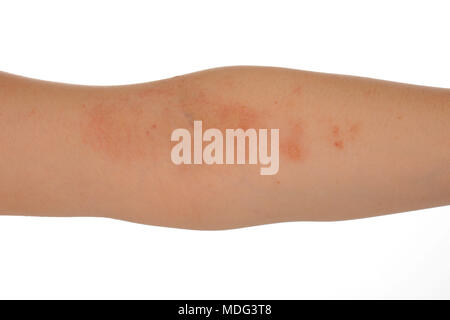 Dermatitis Ekzeme auf der Haut der Arm der Frau, auf weißem Hintergrund Stockfoto