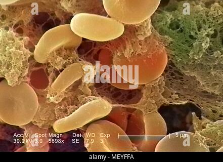 Die roten Blutkörperchen in einem Fibrinöse Matrix auf der luminalen Oberfläche eines Innewohnung Kreislauf-katheter im Raster-Elektronen-Mikroskop (REM) Bild mit freundlicher Genehmigung Seuchenkontrollzentren (CDC)/Janice Haney Carr, 2005 aufgedeckt. Hinweis: Das Bild hat digital über ein modernes Prozess eingefärbt worden. Farben möglicherweise nicht sein - genau. () Stockfoto