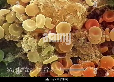 Die roten Blutkörperchen in einem Fibrinöse Matrix auf der luminalen Oberfläche eines Innewohnung Kreislauf-katheter im Raster-Elektronen-Mikroskop (REM) Bild mit freundlicher Genehmigung Seuchenkontrollzentren (CDC)/Janice Haney Carr, 2005 aufgedeckt. Hinweis: Das Bild hat digital über ein modernes Prozess eingefärbt worden. Farben möglicherweise nicht sein - genau. () Stockfoto