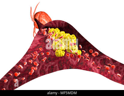 Die Bildung von Cholesterin, Fett, Arterie, Vene, Herz. Einengung der Vene für fat Bildung Stockfoto