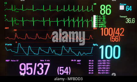 Eine schwarze geschirmt Monitor zeigt normale Sinusrhythmus durch supraventrikuläre Tachykardie in Grün gefolgt, den Blutdruck in Rot, Sauerstoffgehalt in Blau. Stockfoto