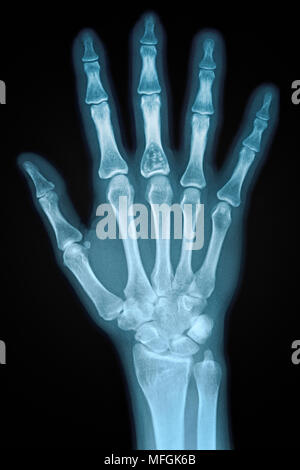 Hand X-ray von einem erwachsenen weiblichen Stockfoto