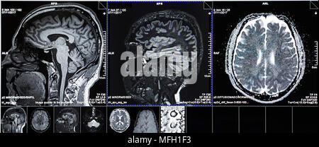 Die Magnetresonanztomographie (MRT) scan-CT Scans von menschlichen Kopf auf einem Ultraschall Computer überwachen. Stockfoto