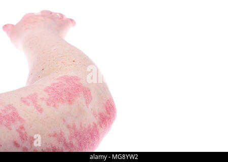 Dermatologische Hautkrankheit Psoriasis, stärker auf Ellenbogen, Hand. Rötung und trockenen Patches, allergischen Ausschlag Dermatitis, Ekzem der Haut. Studio Foto Stockfoto