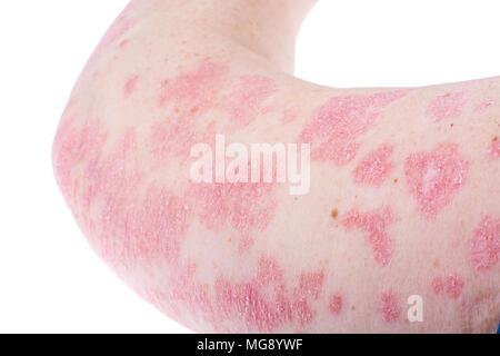 Dermatologische Hautkrankheit Psoriasis, stärker auf Ellenbogen, Hand. Rötung und trockenen Patches, allergischen Ausschlag Dermatitis, Ekzem der Haut. Studio Foto Stockfoto