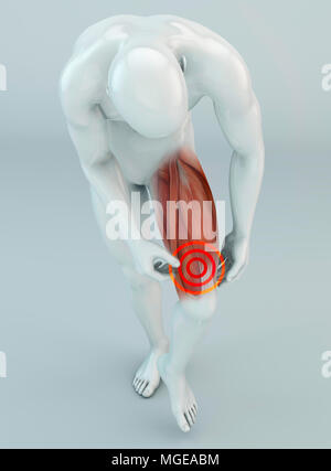 Muskel reißen, Oberschenkelmuskulatur über dem Knie. Schmerzen im Bein und Bänder. Menschliche Körper, 3D-Rendering Stockfoto