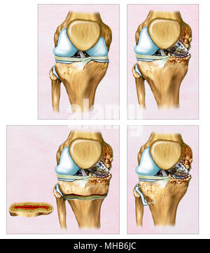 Beschreibende Darstellung eine Osteotomie oder Korrektur der Knie Stockfoto