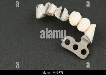 Beschädigte zahnmedizinische cermet Brücke Prothese auf eine lamellare Implantat Stockfoto