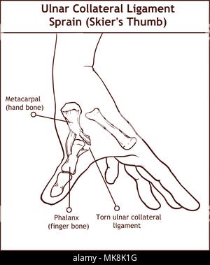 Ulnare Collateral Ligament Verstauchung (Skifahrer Daumen) Stock Vektor