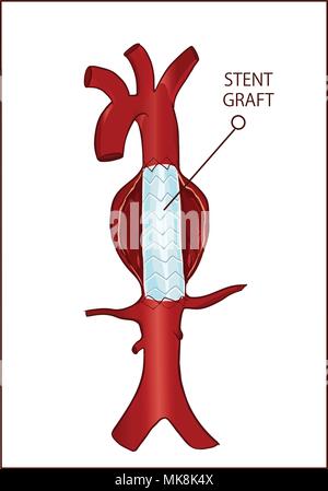 Vektor-, Thorax (absteigend) Aortenaneurysma und Endovaskuläre Chirurgie Stock Vektor