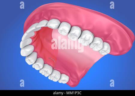 Einzelne fehlende Zahn - herausnehmbare Teilprothese. 3D-Darstellung Stockfoto
